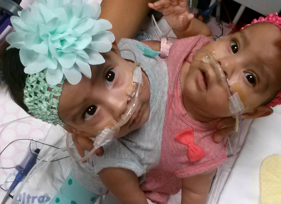 Conjoined Twins Separated In Texas [+PHOTOS] 10Month Old Conjoined